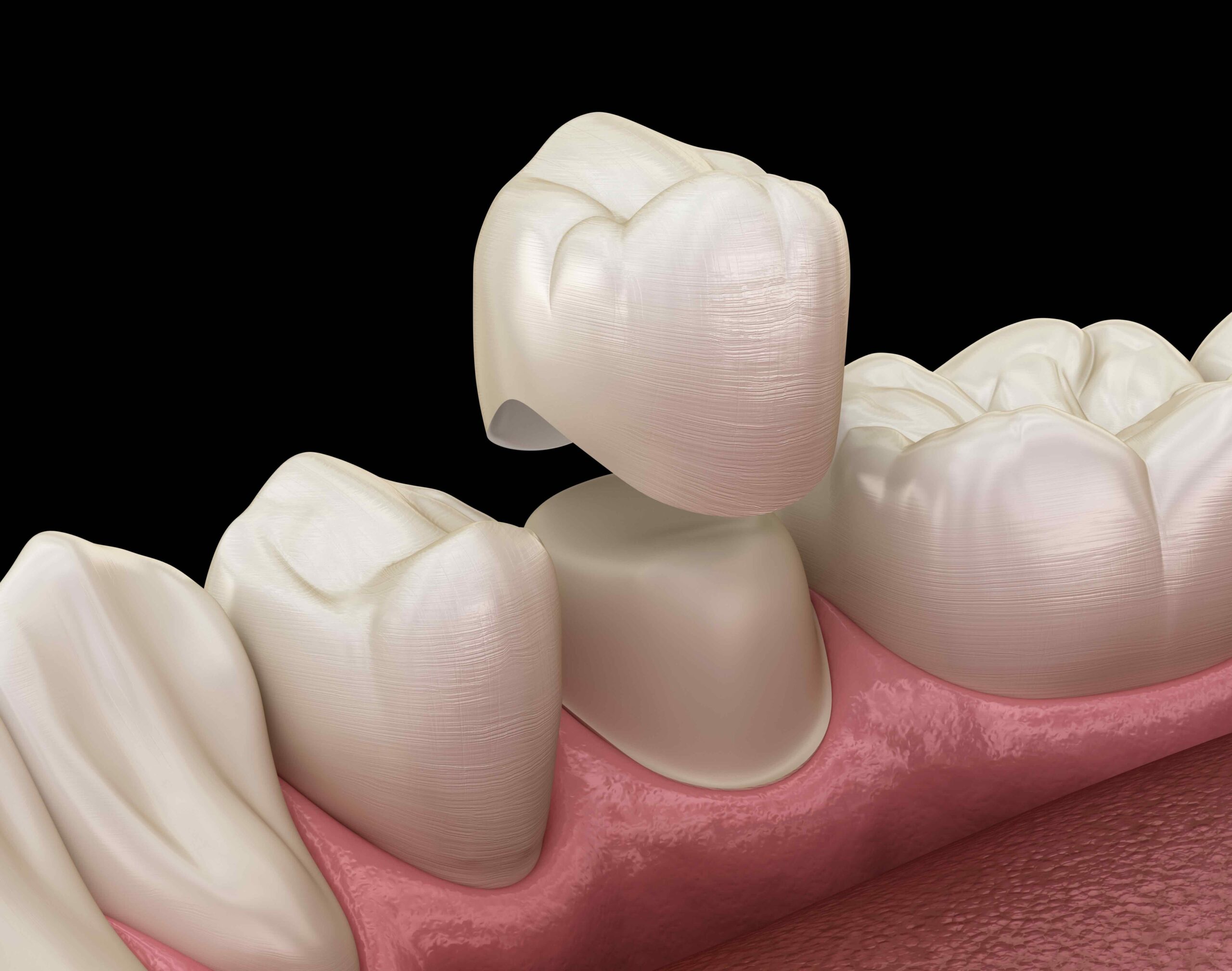 Close-up of veneers and crowns displayed by a Colorado Springs, CO dentist at Cheyenne Mountain Dental Care, showing the differences in coverage and application.